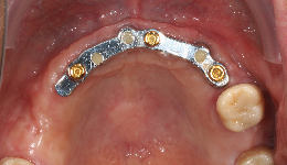 Bar with Locators on Upper Implants	